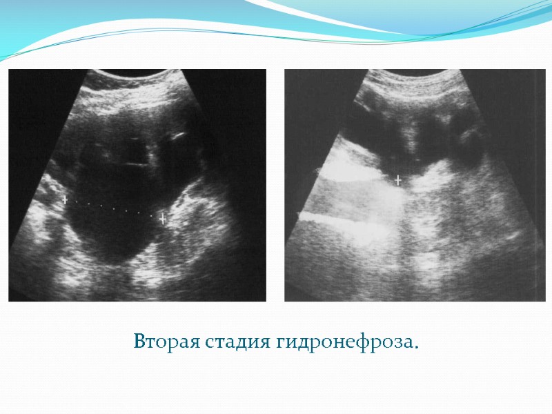 Вторая стадия гидронефроза.